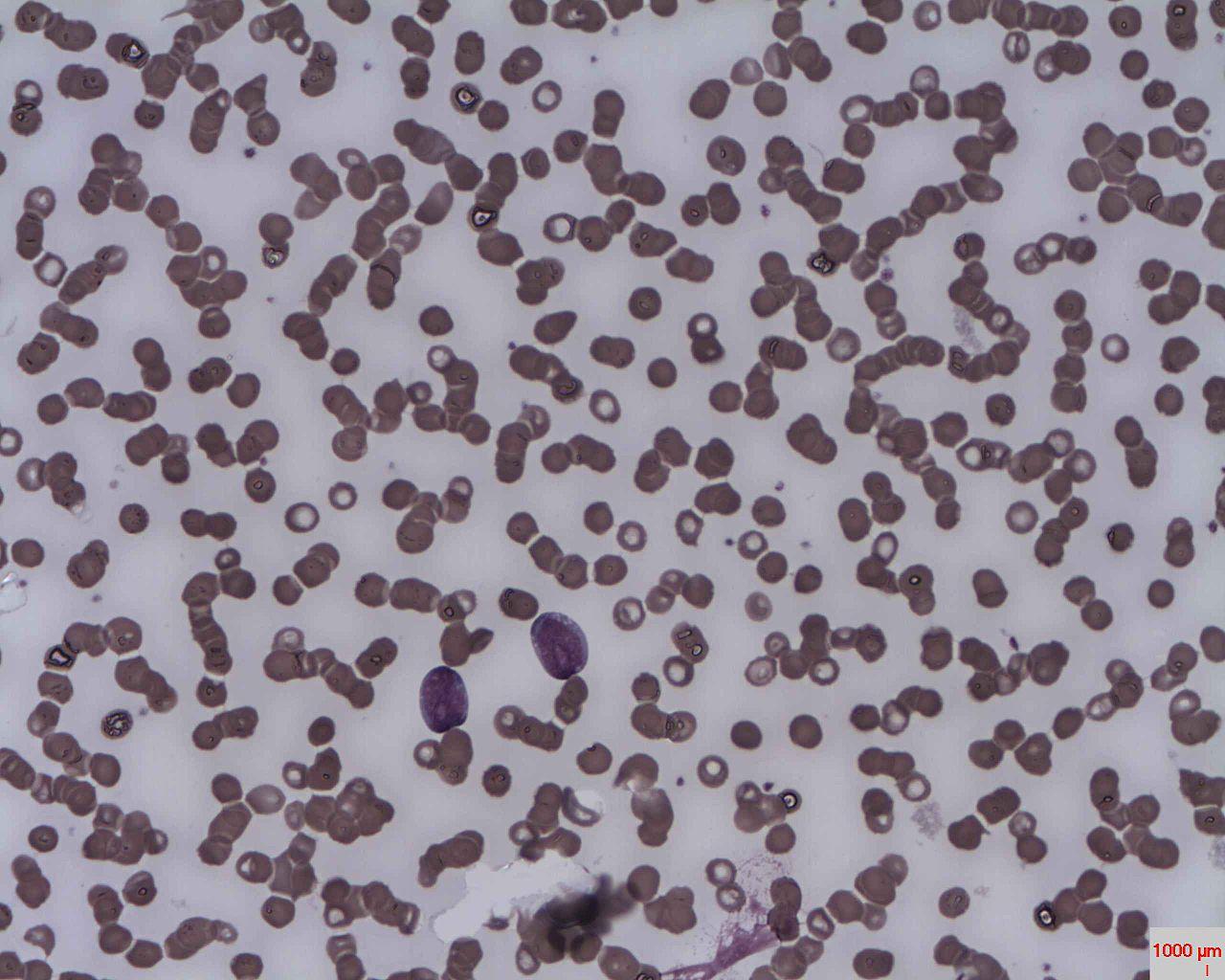 Acute lymphoblastic Leukaemia