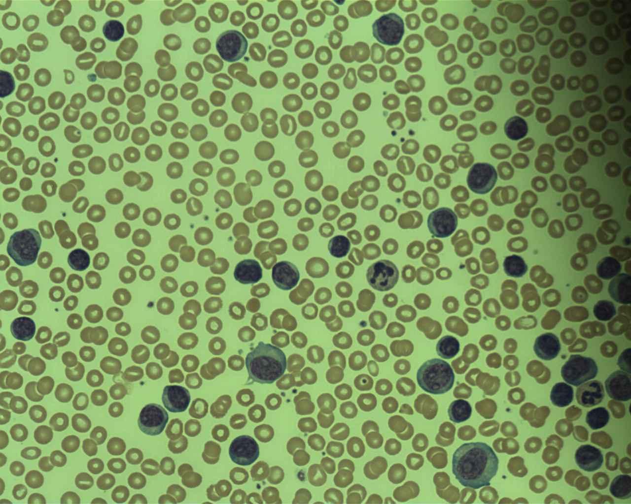 Lymphoblastic Leukaemia