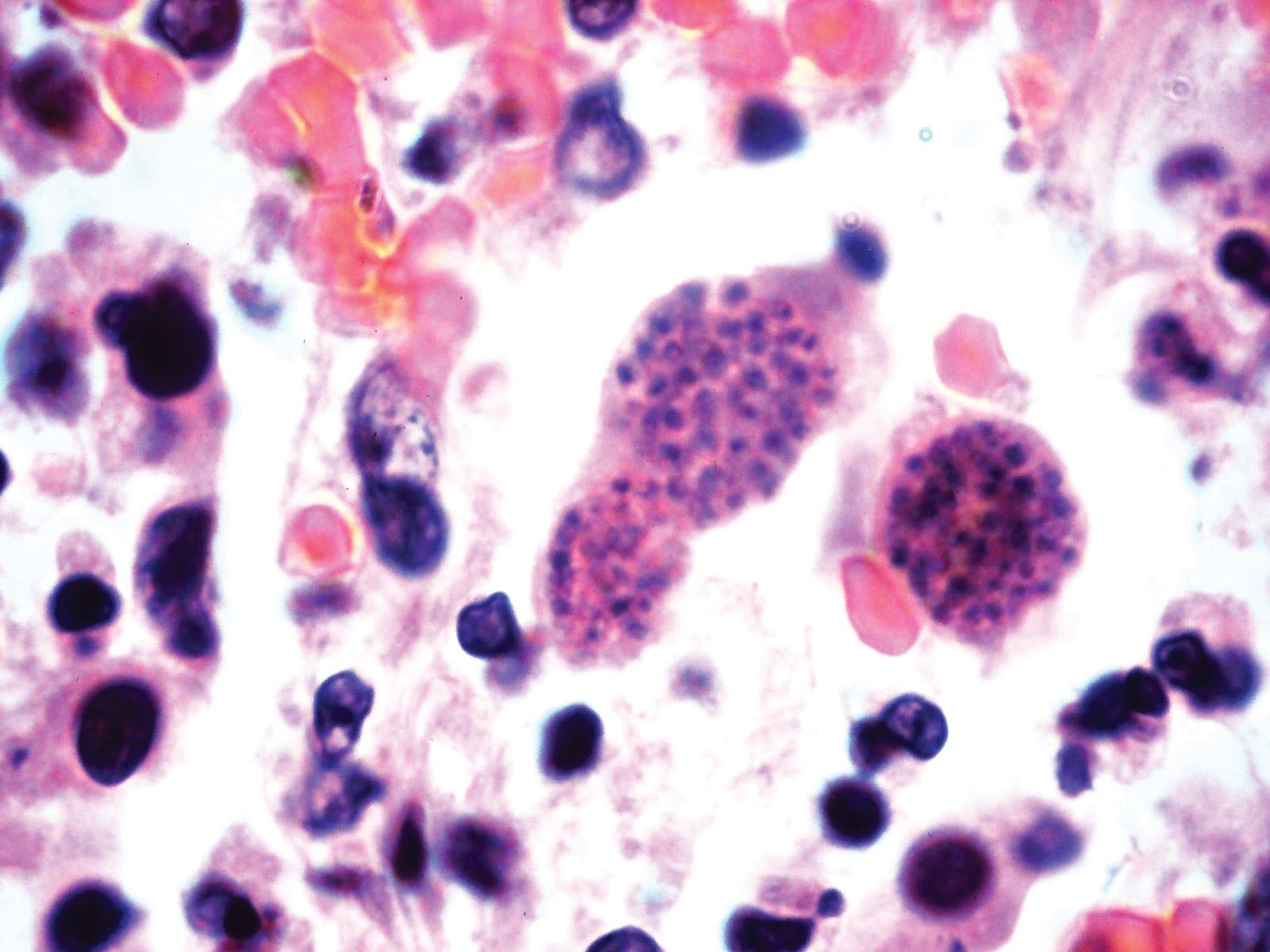 Toxoplasmosis is caused by the parasite Toxoplasma gondii. Yale Rosen/Flickr