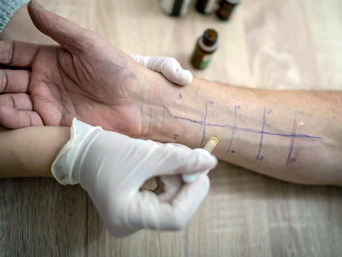 Allergy test - Credit: MajaMitrovic/Getty Images