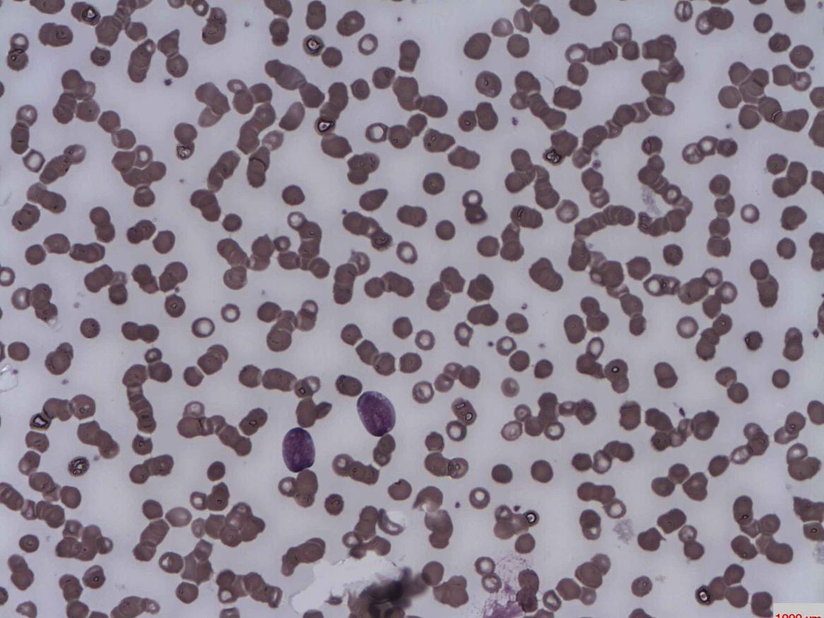 Acute lymphoblastic Leukaemia
