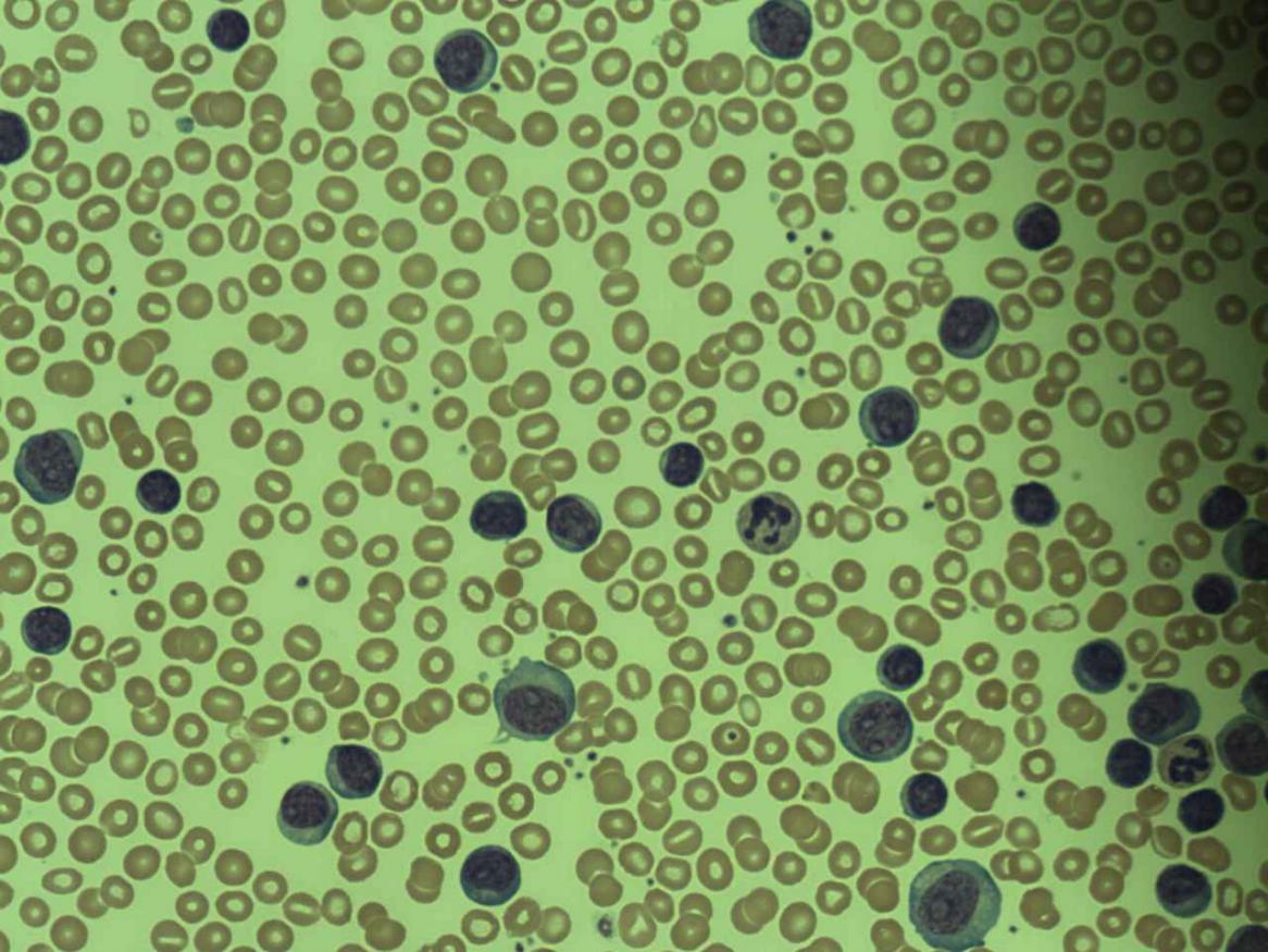 Lymphoblastic Leukaemia