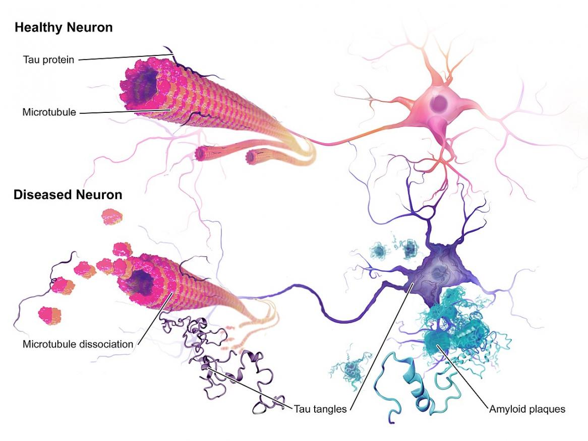 An illustration of the neuropathology of Alzheimer's disease - BruceBlaus / CC BY-SA